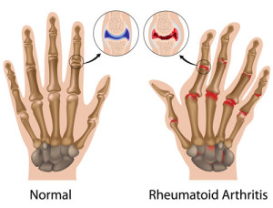 rheumatoid arthritis