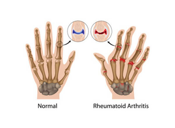 Arthiritis Blog