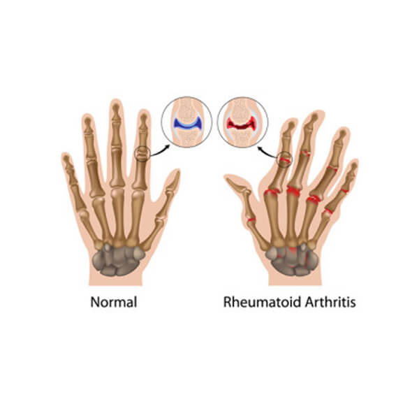 Arthiritis Blog